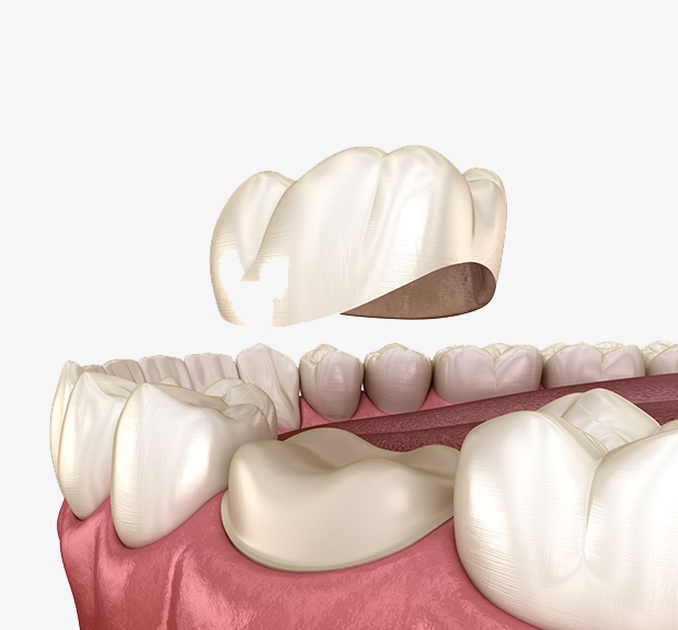 Treatment - The Holland Park Dentist