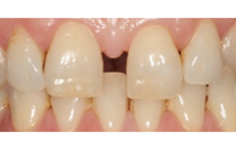 Before - The Holland Park Dentist