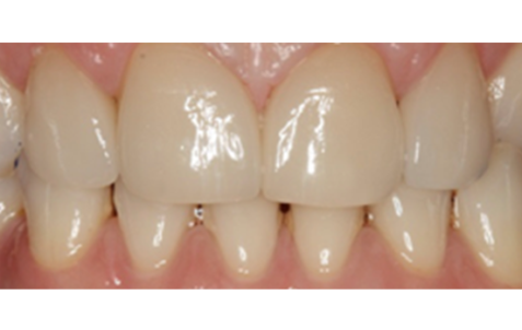 After - The Holland Park Dentist