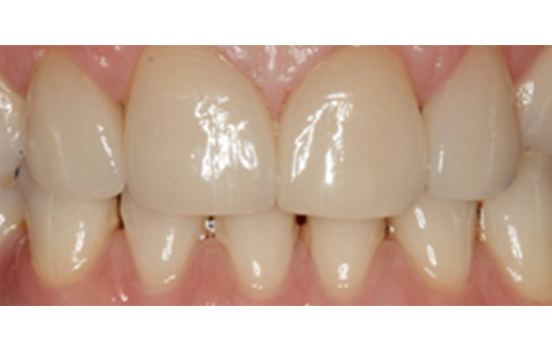 After - The Holland Park Dentist