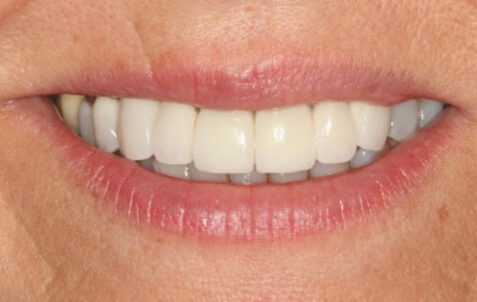 After - The Holland Park Dentist