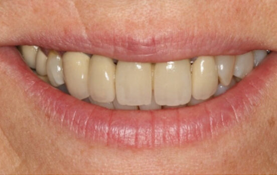 Before - The Holland Park Dentist