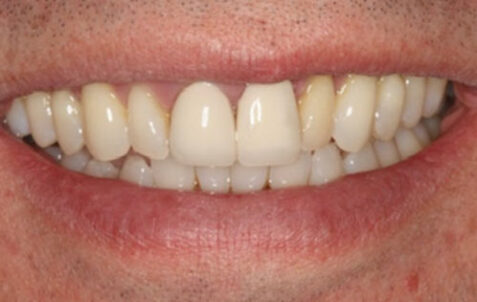 Before - The Holland Park Dentist