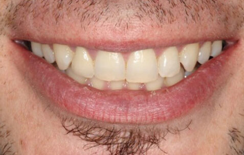 After - The Holland Park Dentist