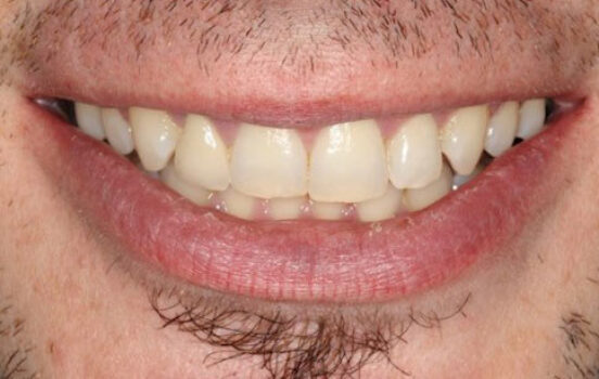 After - The Holland Park Dentist