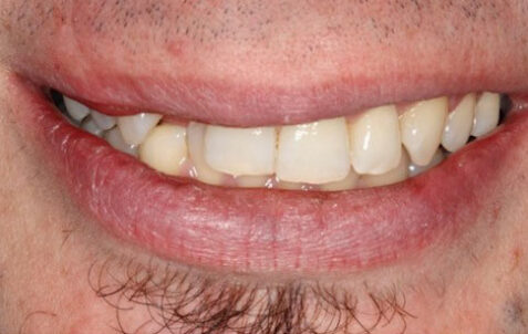 Before - The Holland Park Dentist