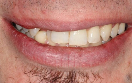 Before - The Holland Park Dentist