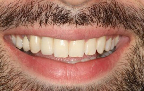 After - The Holland Park Dentist