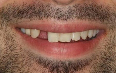 Before - The Holland Park Dentist