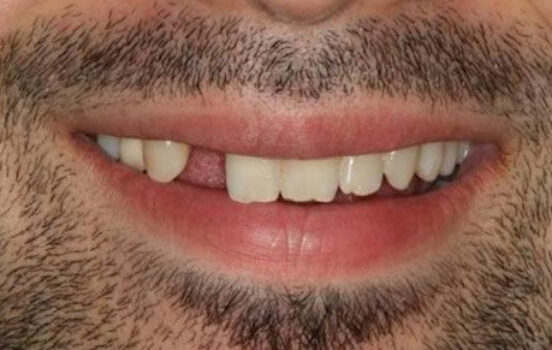 Before - The Holland Park Dentist