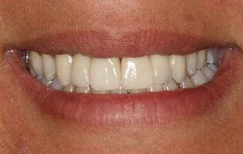 After - The Holland Park Dentist