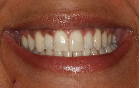 Before - The Holland Park Dentist