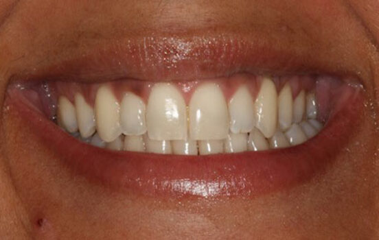 Before - The Holland Park Dentist