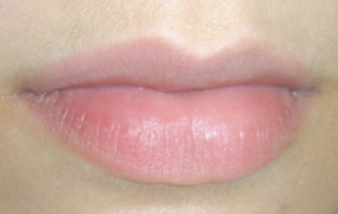 Before - The Holland Park Dentist