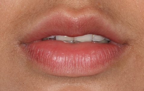 After - The Holland Park Dentist