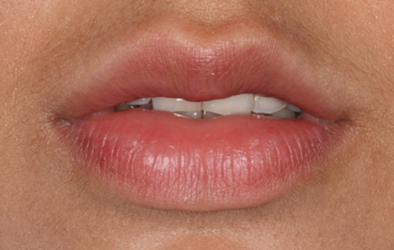 After - The Holland Park Dentist