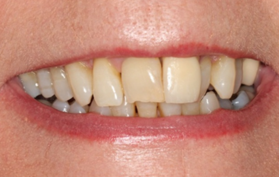 Before - The Holland Park Dentist