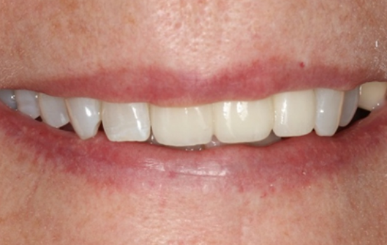 After - The Holland Park Dentist