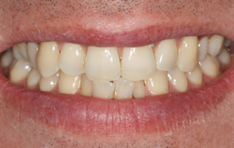 Before - The Holland Park Dentist