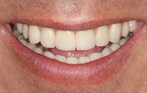 After - The Holland Park Dentist