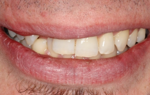 Before - The Holland Park Dentist