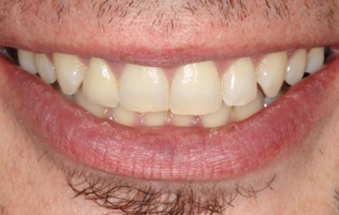 After - The Holland Park Dentist