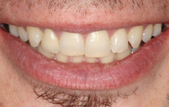 After - The Holland Park Dentist