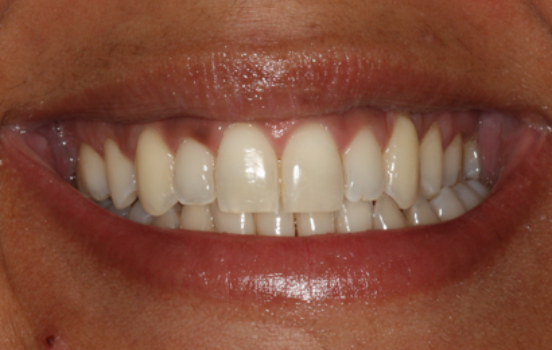 Before - The Holland Park Dentist