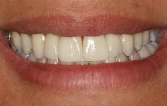 After - The Holland Park Dentist