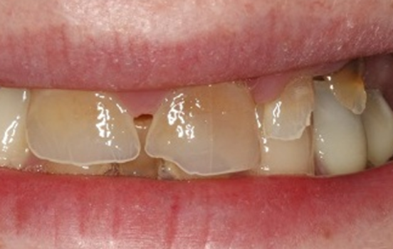 Before - The Holland Park Dentist