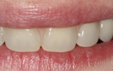 After - The Holland Park Dentist