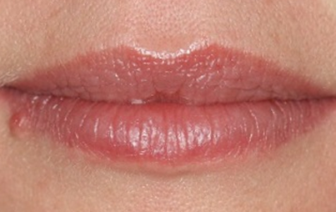 After - The Holland Park Dentist