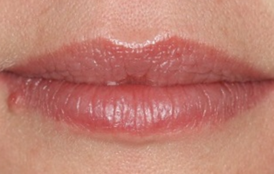 After - The Holland Park Dentist