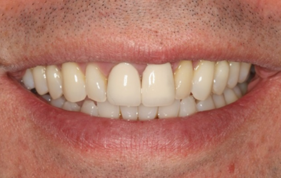 Before - The Holland Park Dentist