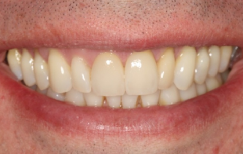 After - The Holland Park Dentist