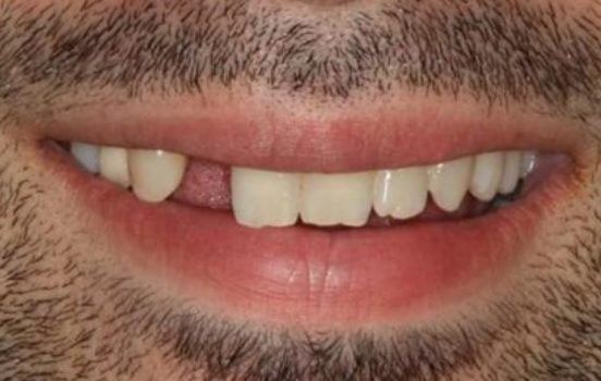 Before - The Holland Park Dentist