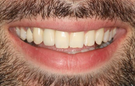 After - The Holland Park Dentist