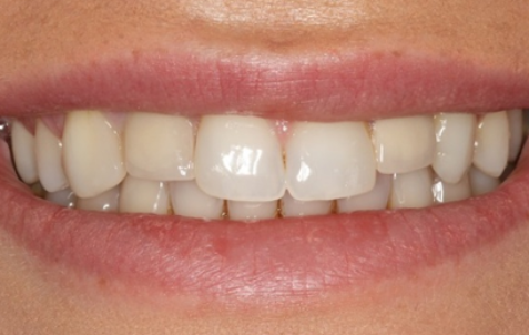 Before - The Holland Park Dentist