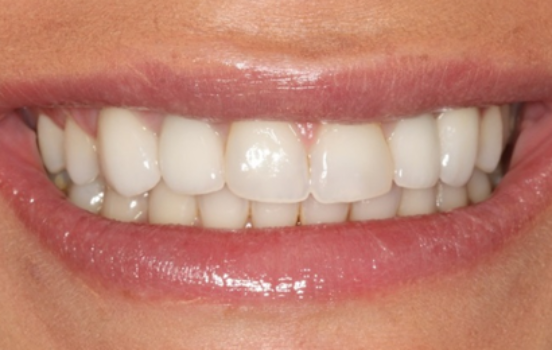 After - The Holland Park Dentist